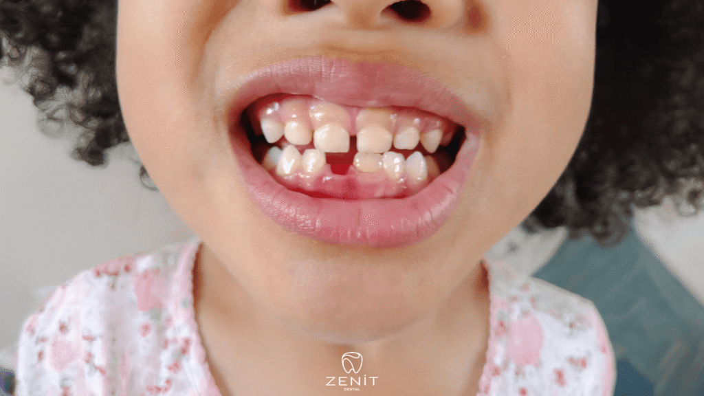 When do milk teeth fall out?