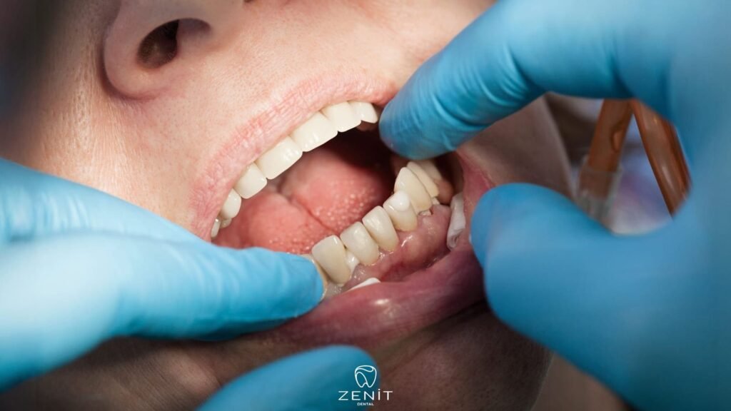 Periimplantitis Nedir