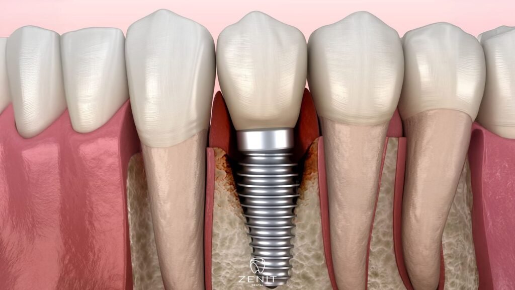 Periimplantitis Nedir