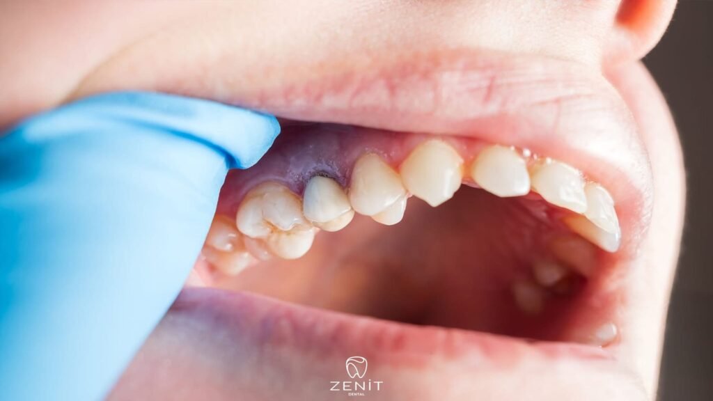 What is Periimplantitis