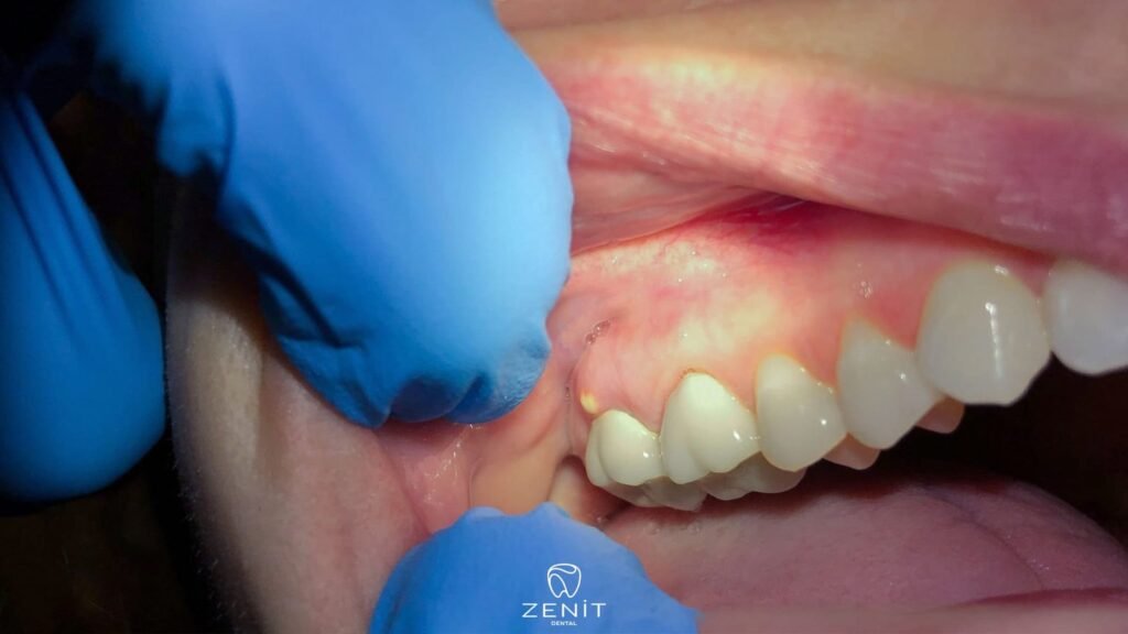 Tooth Abscess