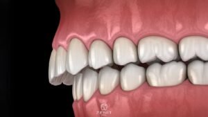overbite nedir