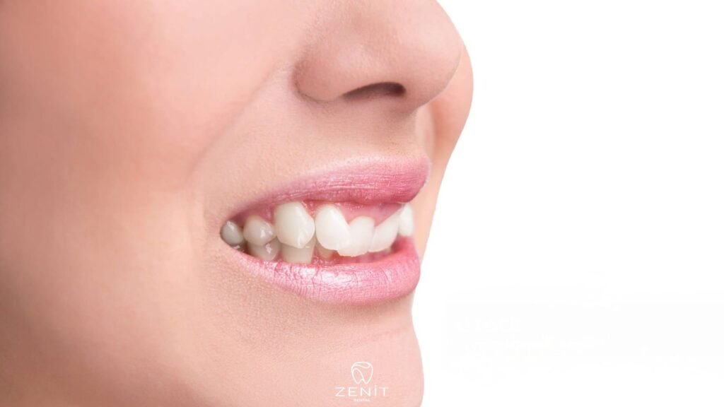 overbite nedir