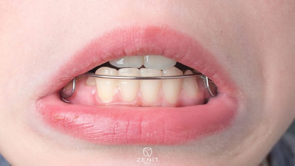 What is a Placeholder