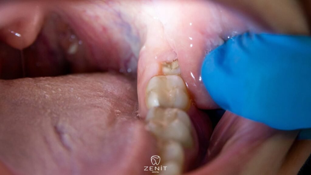 Yirmilik Diş Ağrısı