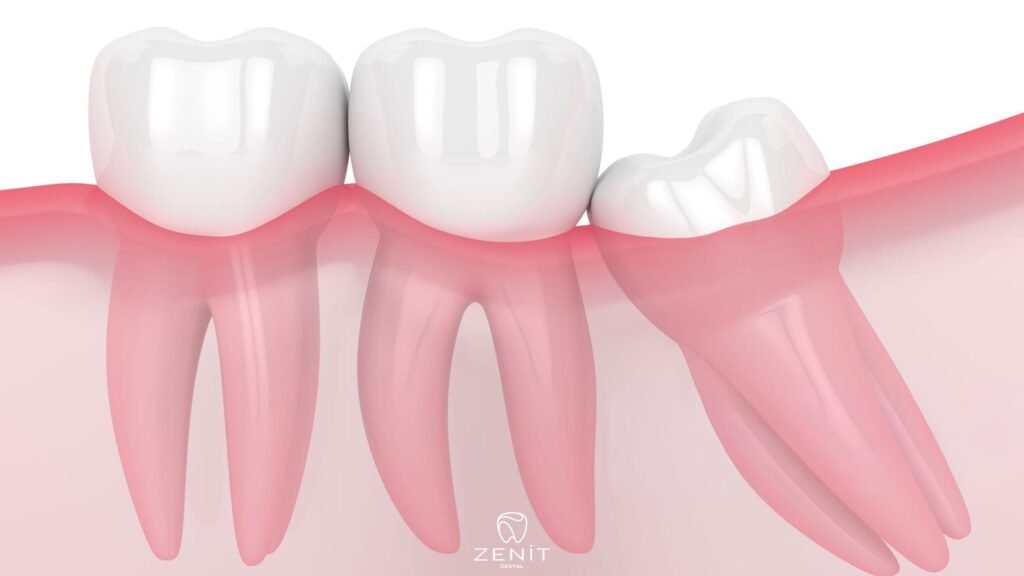 Yirmilik Diş Ağrısı