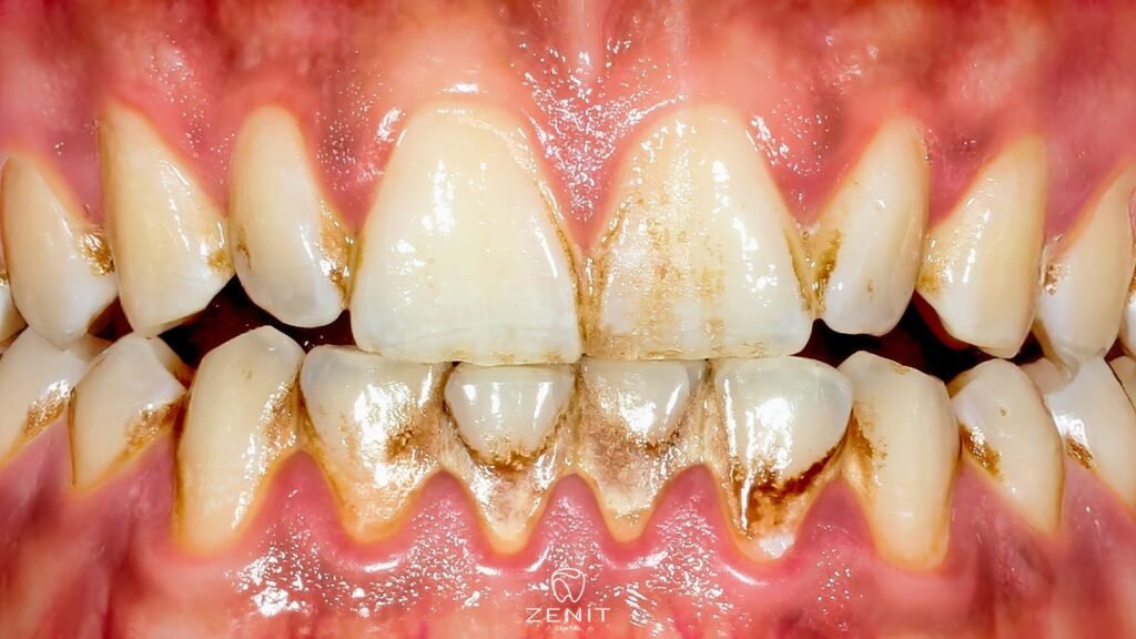 Dişlerimiz Neden Çürür