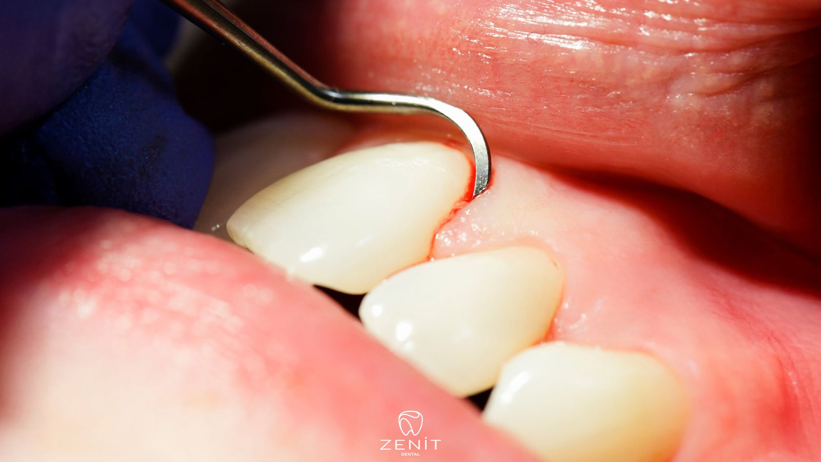 Diş Eti Hastalıkları