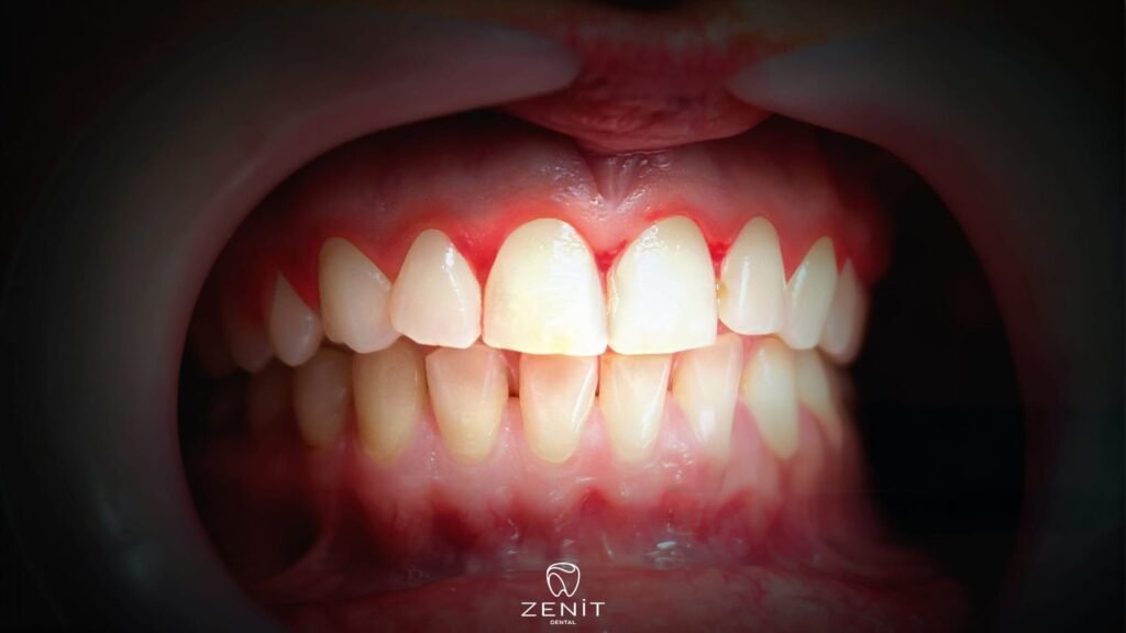 Hamilelik Gingivitisi Nedir