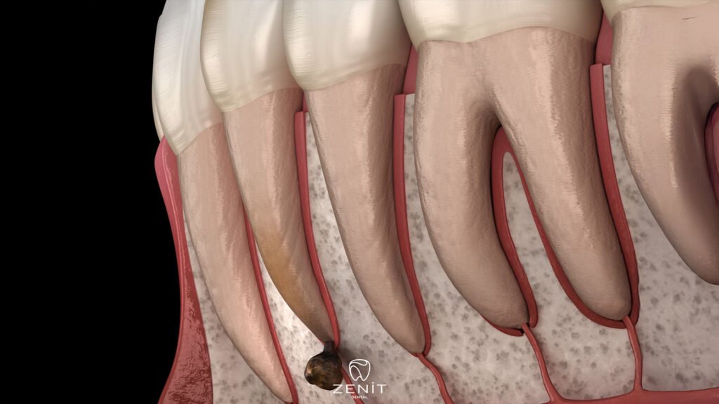 What Is Apical Resection