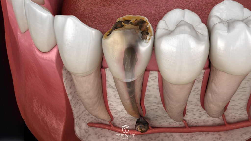 Apikal Rezeksiyon Nedir