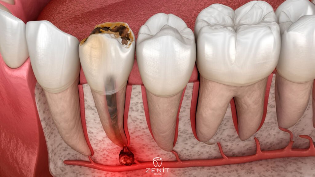 What Is Apical Resection