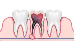 What Is Apical Resection
