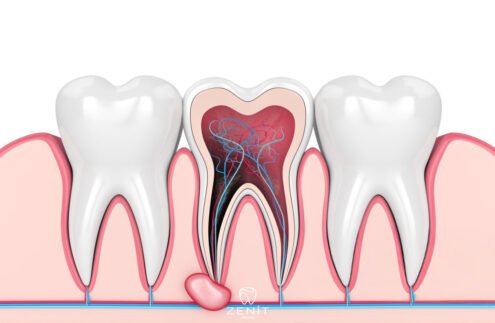What Is Apical Resection