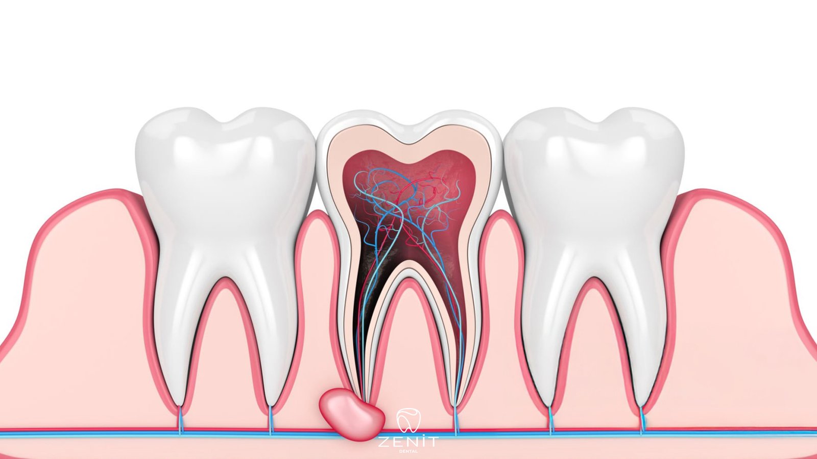 Apikal Rezeksiyon Nedir