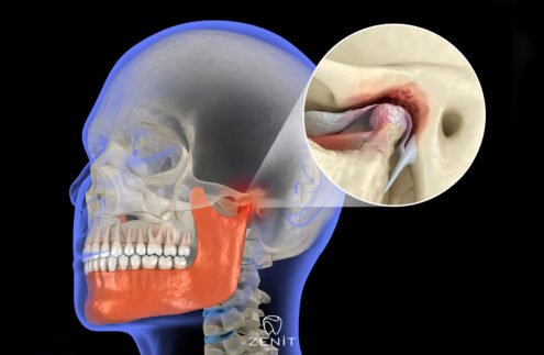 Temporomandibular Eklem Bozukluğu Nedir