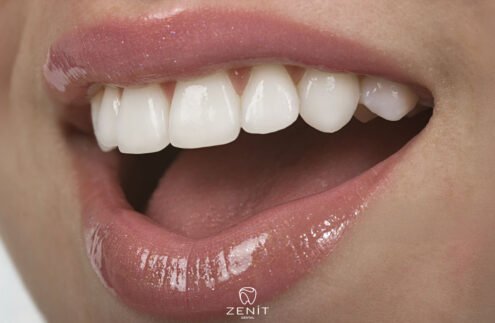 Gülüş Tasarımı Nedir