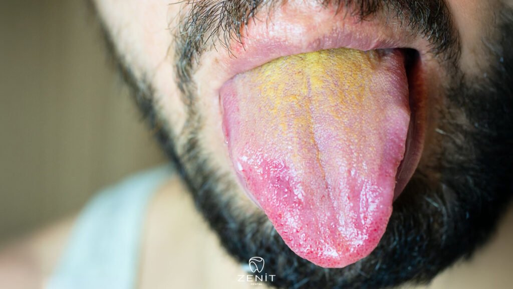 Causes of Yellow Tongue