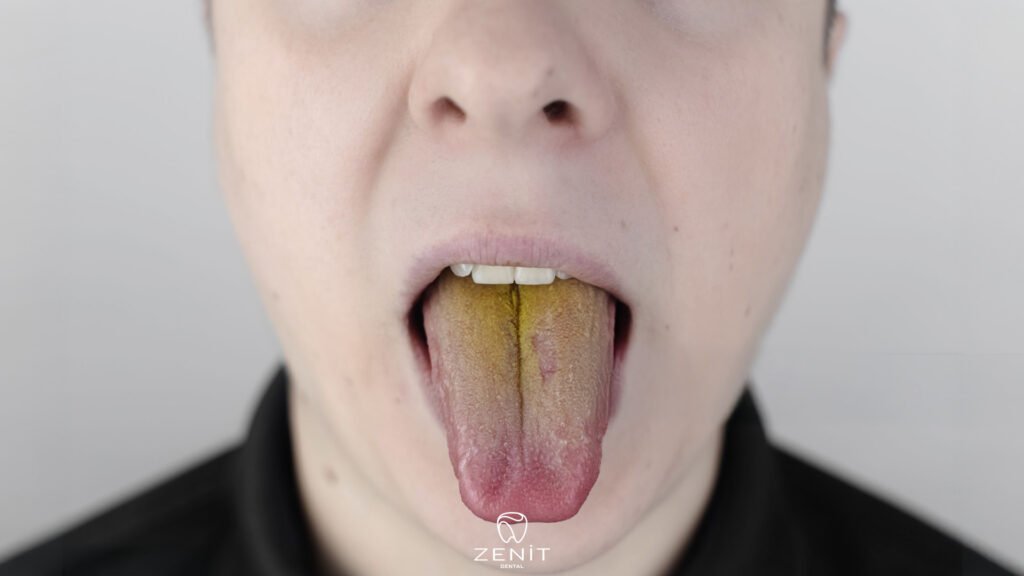 Causes of Yellow Tongue