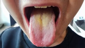 Dil Sararması Nedenleri