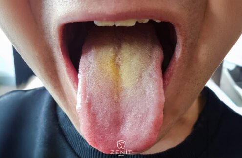 Dil Sararması Nedenleri