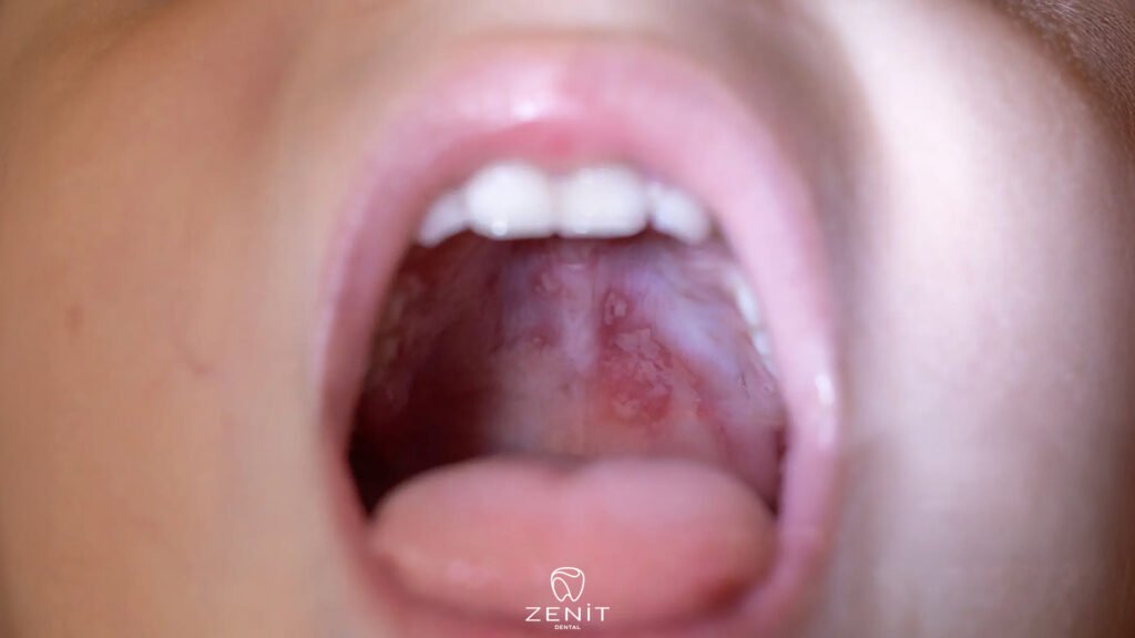 How to Heal Mouth Sores