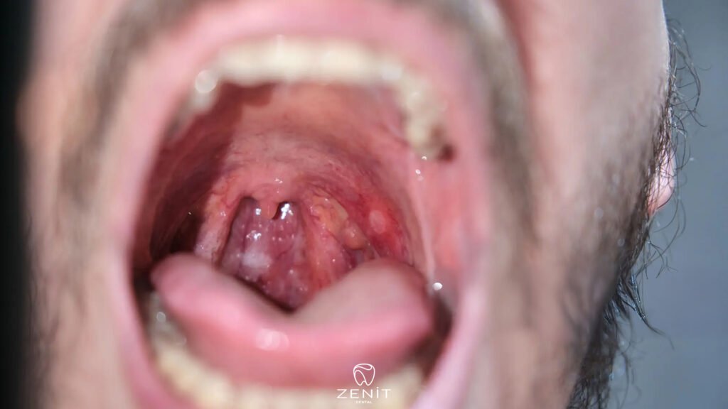 How to Heal Mouth Sores