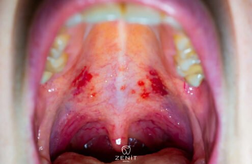 Damak Yarası Nasıl Geçer