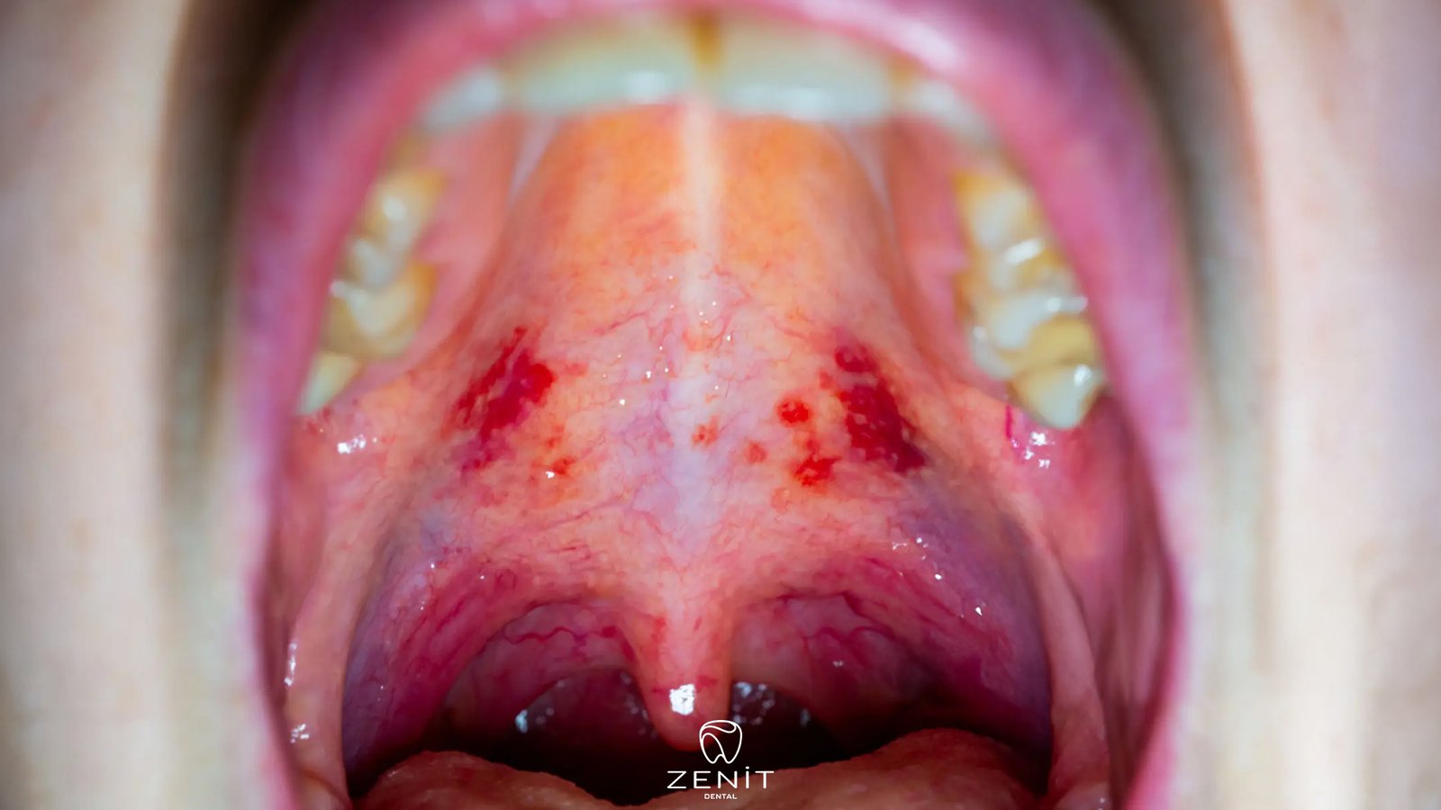 Damak Yarası Nasıl Geçer