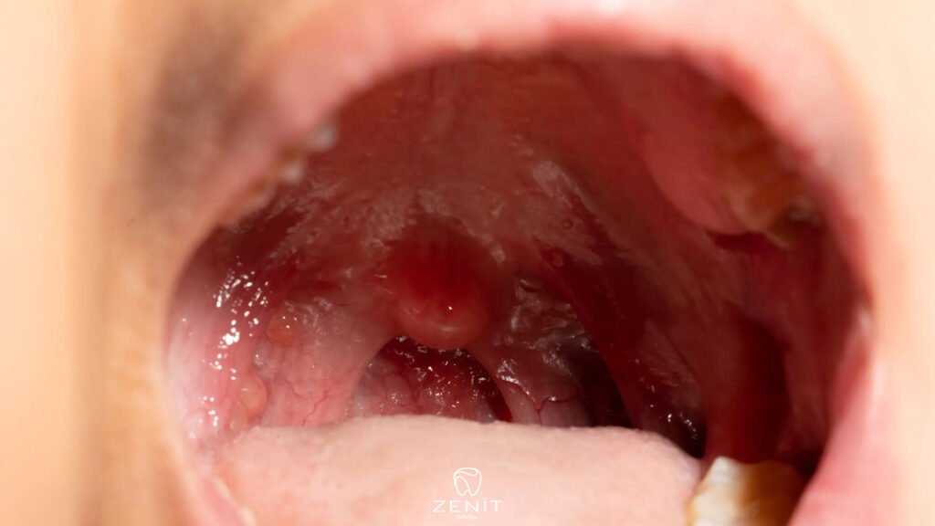 Damak Yarası Nasıl Geçer