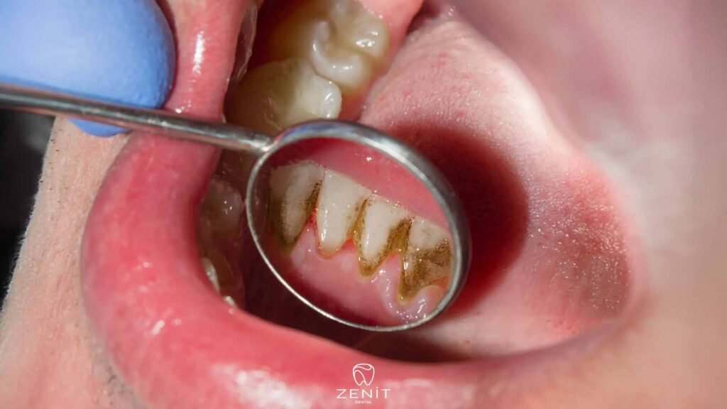 How to Remove Dental Tartar