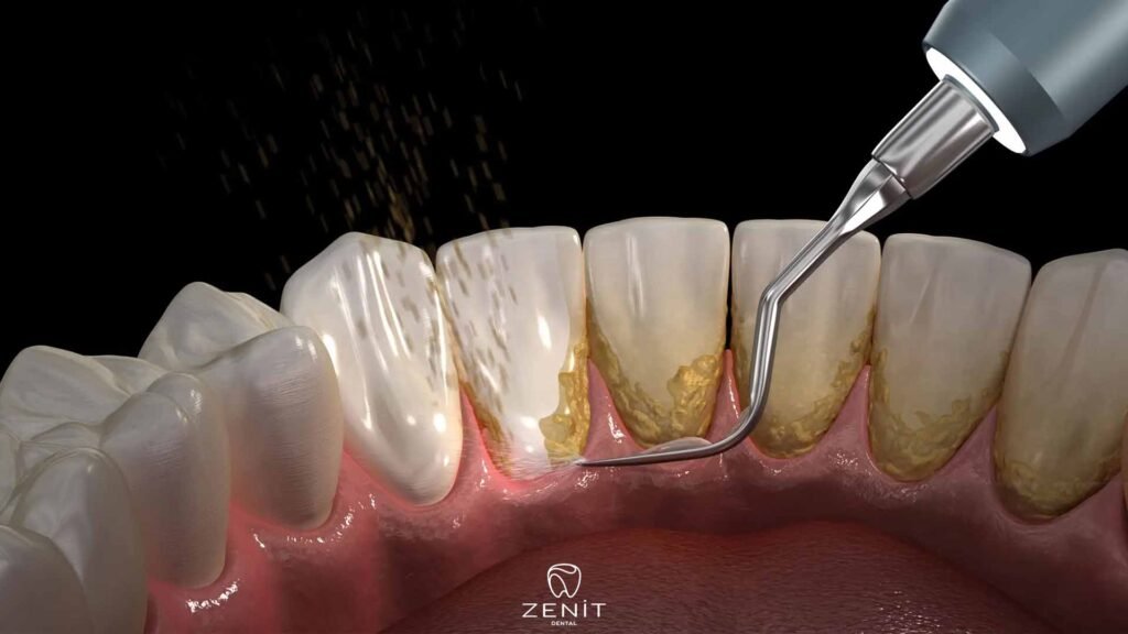 How to Remove Dental Tartar