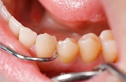 Diş Tartarı Nasıl Temizlenir