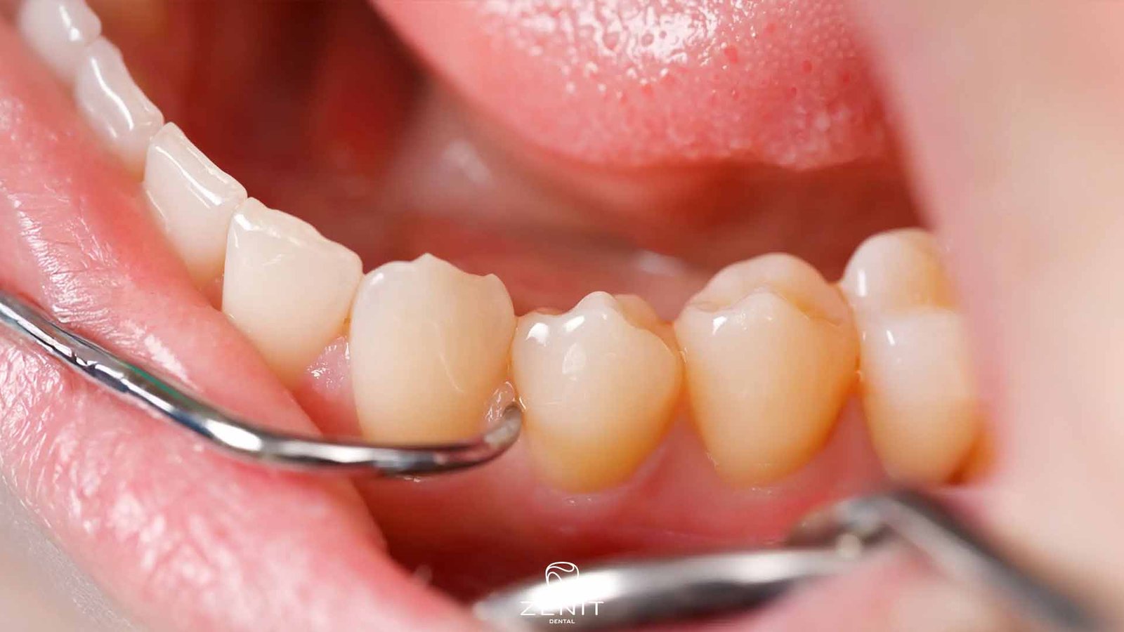 Diş Tartarı Nasıl Temizlenir