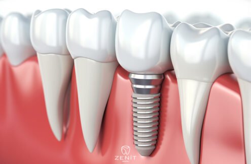 İmplant mı? Köprü mü?