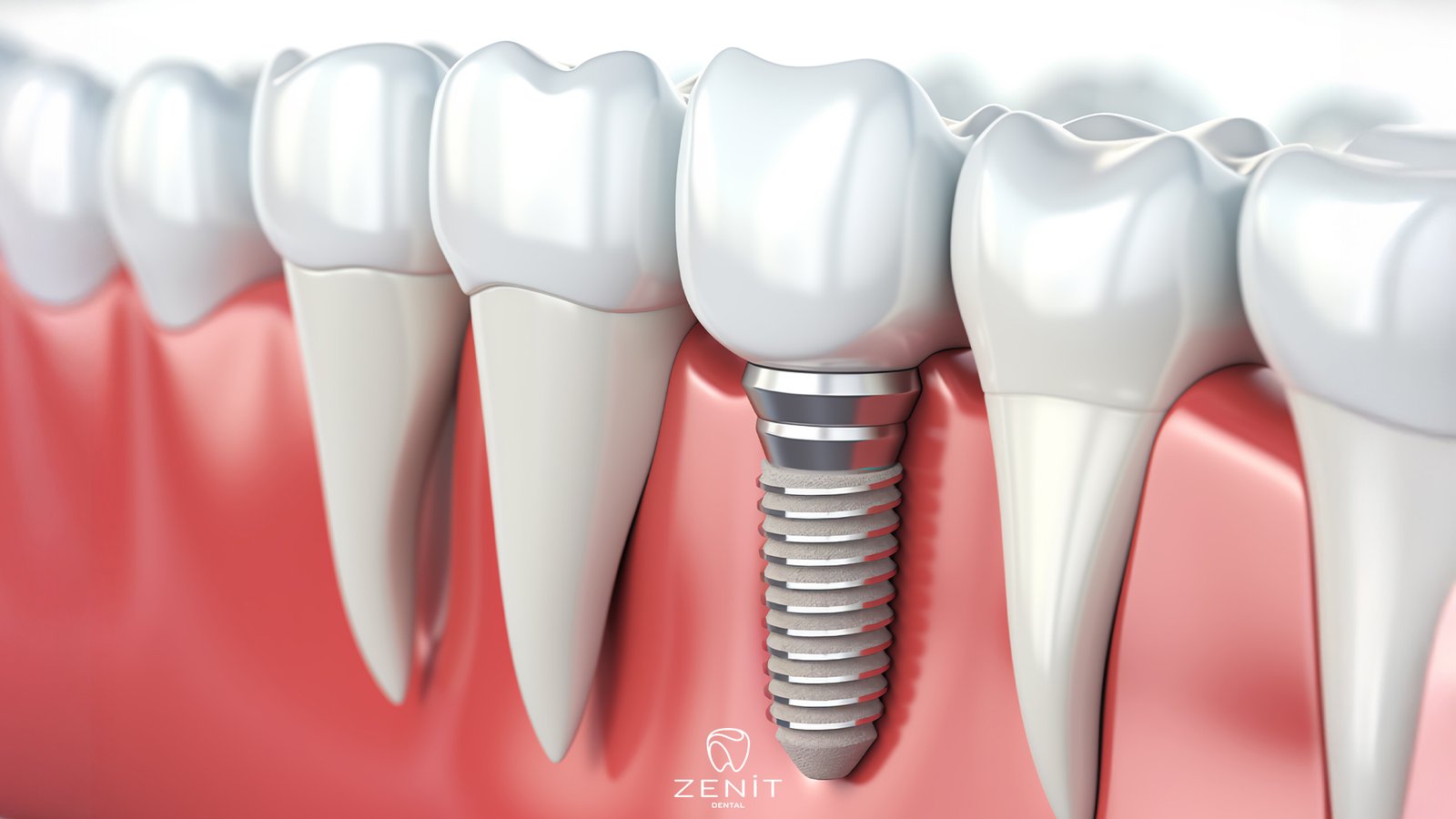 İmplant mı? Köprü mü?