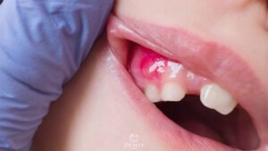 Diş Etinde Yara Neden Olur