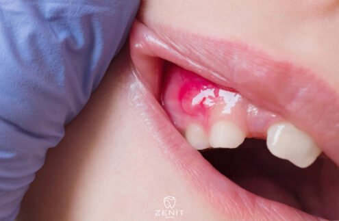 Diş Etinde Yara Neden Olur
