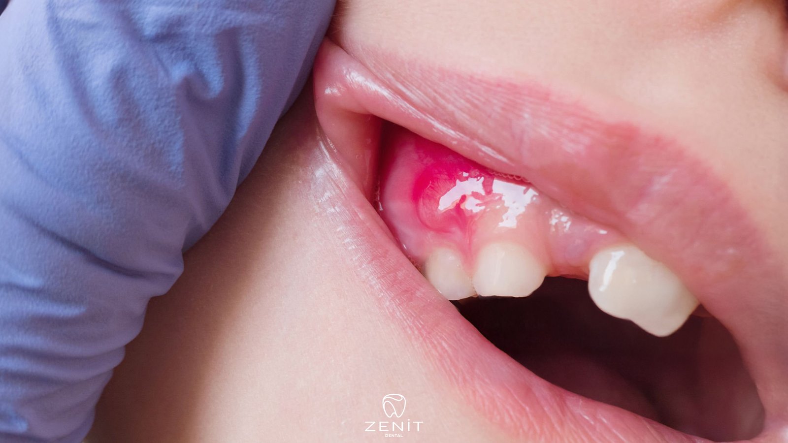 Diş Etinde Yara Neden Olur