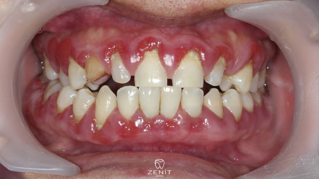 What Causes Sores on the Gums?