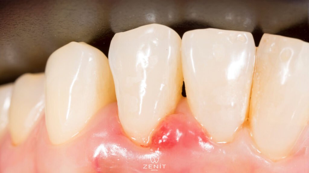 What Causes Sores on the Gums?