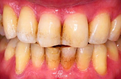 Diş Lekesi Nasıl Geçer