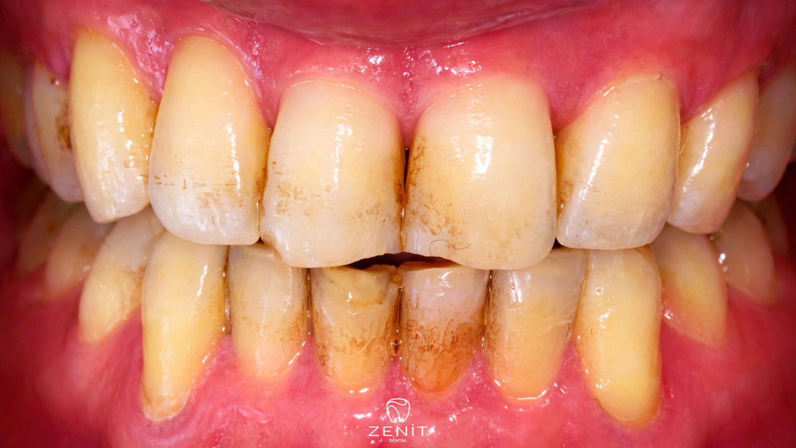 Diş Lekesi Nasıl Geçer