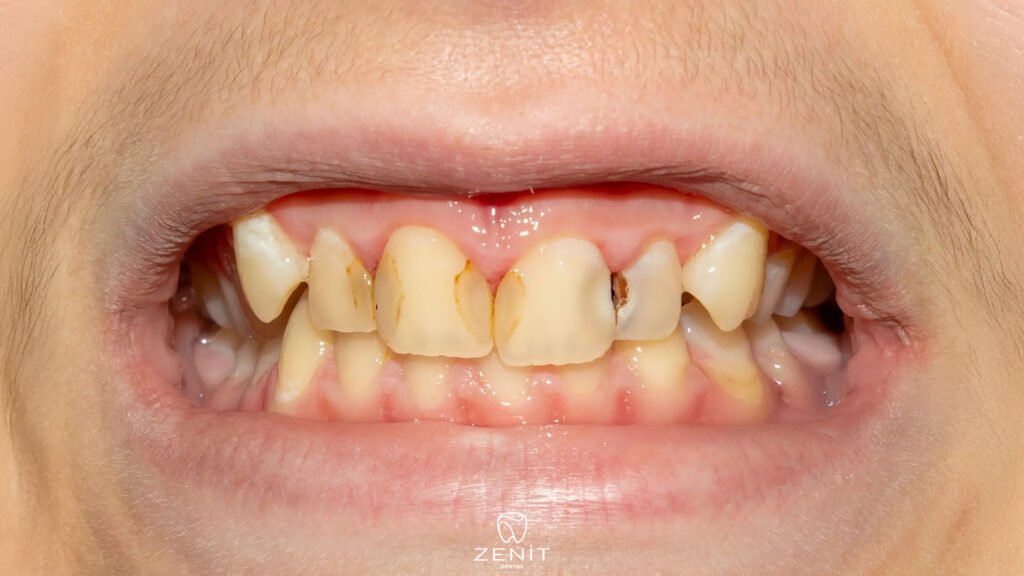 How to Get Rid of Tooth Stains