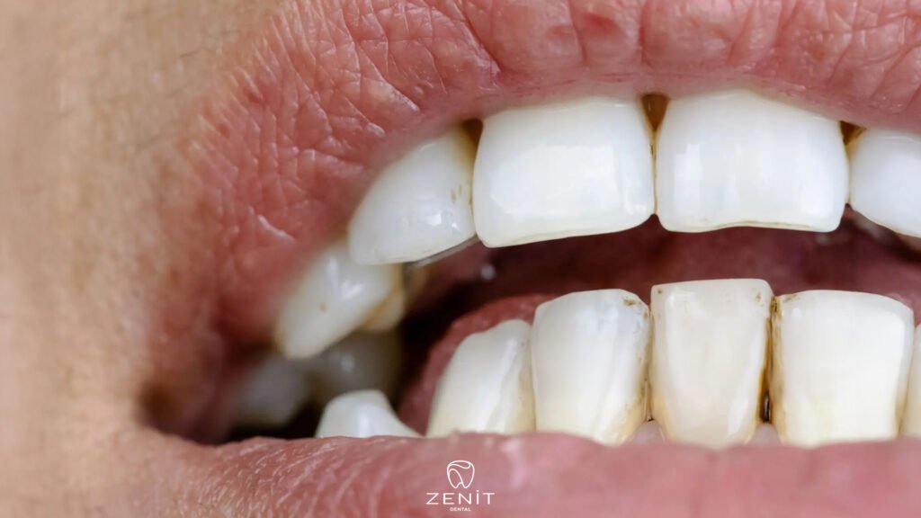 How to Get Rid of Tooth Stains