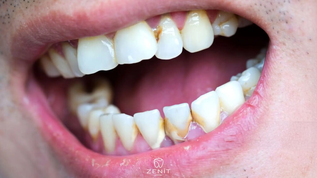 How to Get Rid of Tooth Stains