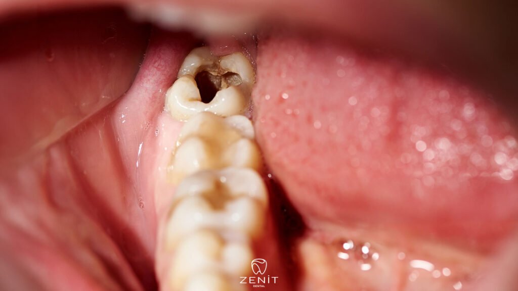 Does a Filled Tooth Decay?