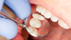 Dolgu Yapılan Diş Çürür Mü