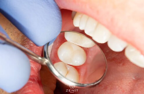 Dolgu Yapılan Diş Çürür Mü