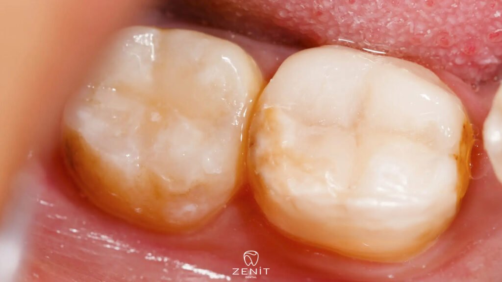 Does a Filled Tooth Decay?